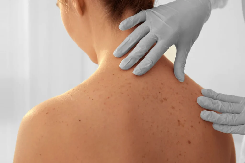 A medical specialist wearing grey protective gloves performing a close clinical inspection of a female patient's upper back and neck to evaluate a widespread skin rash, eczema, or sun spots.