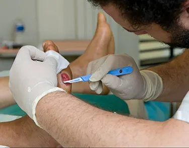 A close-up of a medical specialist in sterile gloves using a surgical scalpel to perform precision wound debridement on a diabetic foot ulcer.