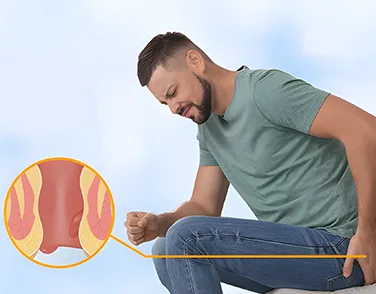 An infographic showing a side profile of a man sitting down in obvious pain while clutching his lower back and hip, alongside a circular anatomical diagram illustrating swollen internal and external hemorrhoids in the anal canal.