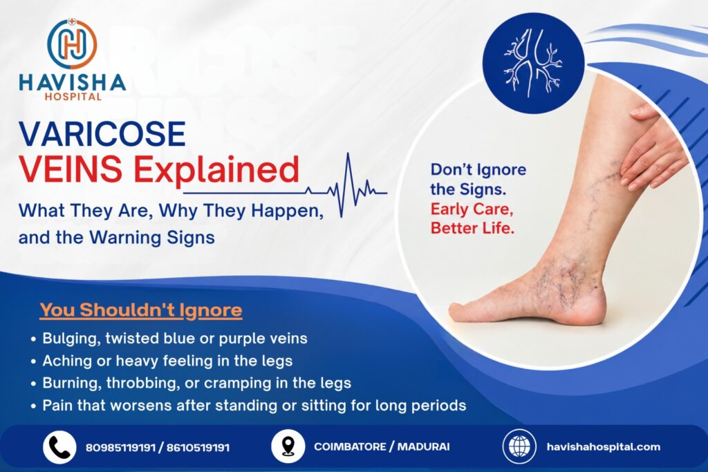 varicose veins explained