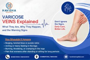 varicose veins explained