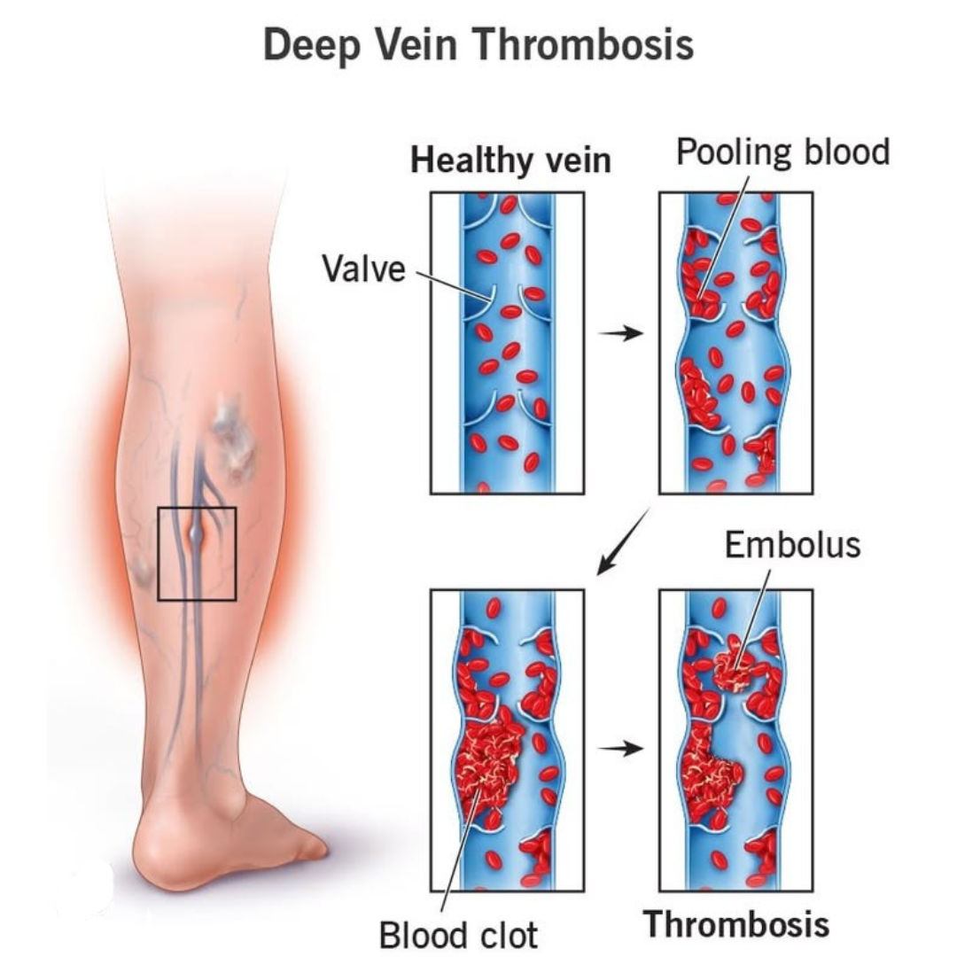 Deep Vein Thrombosis (DVT)