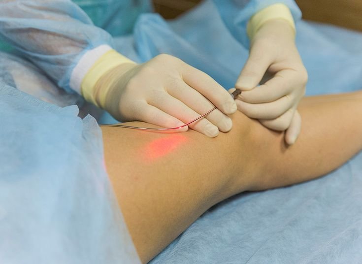 Endovenous laser treatment in coimbatore