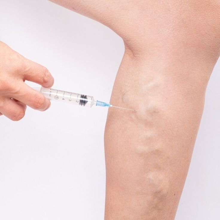Sclerotherapy