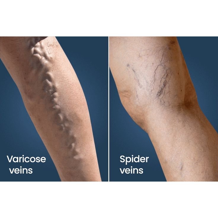 Spider veins & varicose veins are very different and we treat both! Call today +91 8098519191📞_#varicoseveins #varicose #varicoseveintreatment #spiderveins #spiderveinstreatment #treatment #care #vein #veins