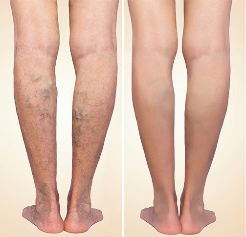 Varicose vein before and after image at havisha hospital