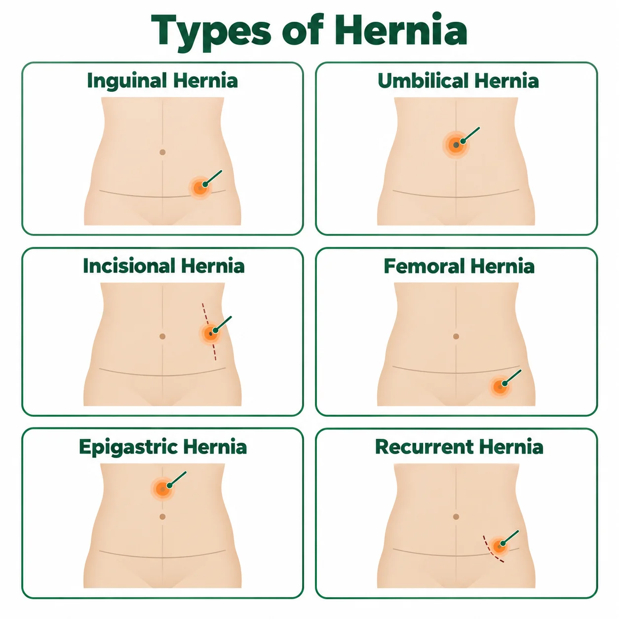 Types of hernia